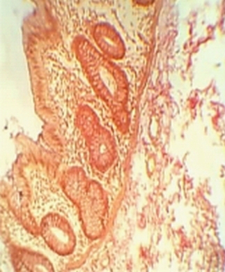 Рис. 3. Морфология стенозированной части толстой кишки (окраска по Ван-Гизону). Ув. 1:40