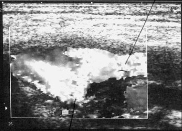 Рис. 2. Ультразвуковая ангиосканограмма. Зона дистального анастомоза через 1 месяц после операции
