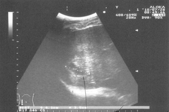Рис. 2. Тот же пациент. Ультразвуковая картина на 2 сутки после пункции и санации полости абсцесса, отмечается наличие жидкостного компонента в полости абсцесса.