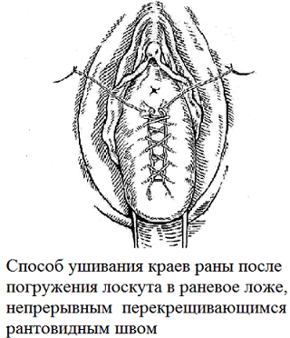 Рис. 1. Схематические изображения операции при цистоуретроцеле.