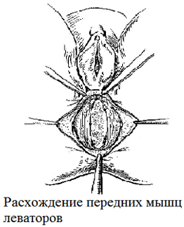 Рис. 2. Схематические изображения операции при ректоцеле.