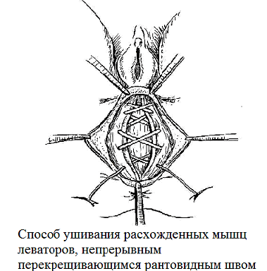 Рис. 2. Схематические изображения операции при ректоцеле.