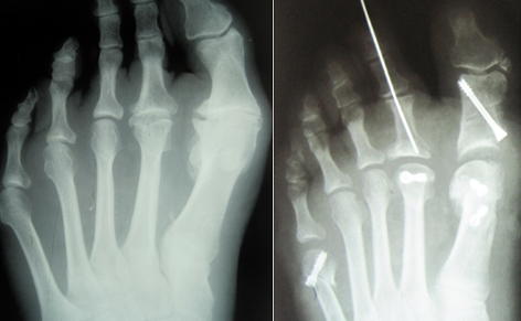 Рис 12. Результат комбинированного вмешательства при тяжелом Hallux limitus, находящимся на грани с Hallux rigidus.