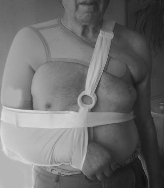 Рис. 1а. Первый этап фиксации (вид спереди).