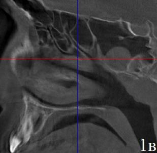 Рис. 1. Вариант сочетанной патологии, обнаруженной на 3D РКТ. Аксиальная (а), коронарная (б), парасагитальная (в) проекции. Пациент с заложенностью носа. Диагностирован хронический гипертрофический ринит, гипертрофия аденоидных вегетаций I-II степени. Случайно обнаружены кисты верхне-челюстных и правой клиновидной пазух, буллезная средняя носовая раковина слева.
