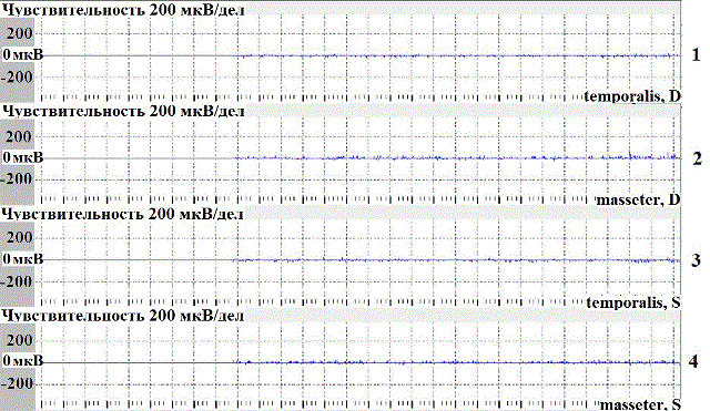 Рис.1. Электромиограмма испытуемой С., 36 лет в покое: 1- temporalis, D (dextra); 2-masseter, D (dextra); 3-temporalis, S (sinistra); 4-masseter, S (sinistra). Чувствительность 200 мкВ/дел. Рис.1. Электромиограмма испытуемой С., 36 лет в покое: 1- temporalis, D (dextra); 2-masseter, D (dextra); 3-temporalis, S (sinistra); 4-masseter, S (sinistra). Чувствительность 200 мкВ/дел.