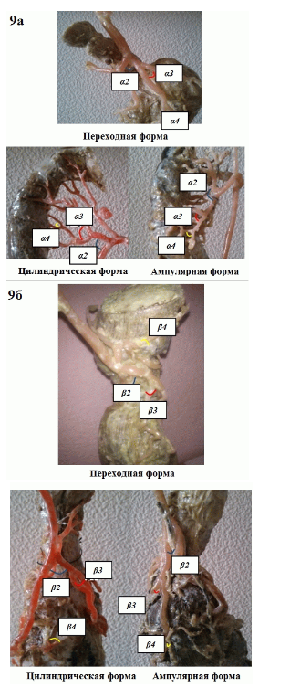 Рис. 9. Портальная система различных форм прямой кишки человека. Фигурными скобками указаны углы образования вен четырех генераций в сагиттальной (а) и фронтальной (б) плоскостях Рис. 9. Портальная система различных форм прямой кишки человека. Фигурными скобками указаны углы образования вен четырех генераций в сагиттальной (а) и фронтальной (б) плоскостях