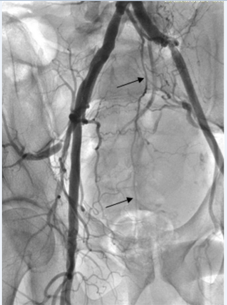 Рис. 3. Средняя сакральная артерия (указана стрелками) доходит до среднеампулярного отдела