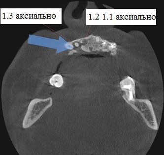 Рис. 2.5. Аксиальная плоскость 1.1-1.3