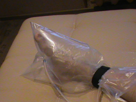 Рис. 1. Обработка послеоперационной раны озонокислородной смесью в специальном &laquo;сапоге&raquo;.