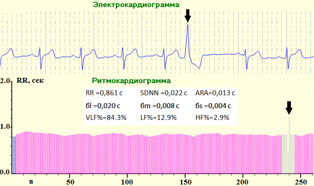 Рис. 1. РКГ и ЭКГ (проба рА) пациента У., 53 лет со СтСт 3 ФК ГБ: ВСР снижена, понижена максимальная реакция в пробе, в спектральном анализе преобладает гуморально-метаболическая регуляция за счет значительного уменьшения LF% и HF%, на ЭКГ – ЖЭС после принятия НГ.