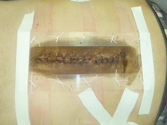 Рис. 1. Использование устройства для профилактики эвентерации