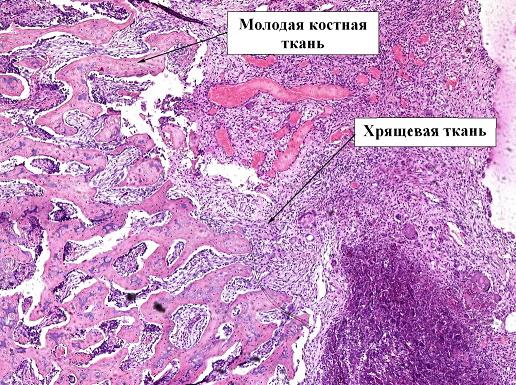 Рис. 8. Препарат костной мозоли перелома бедра кролика, 4 экспериментальная группа, срок 28 дней, окраска гематоксилин-эозином, ув. х2,5