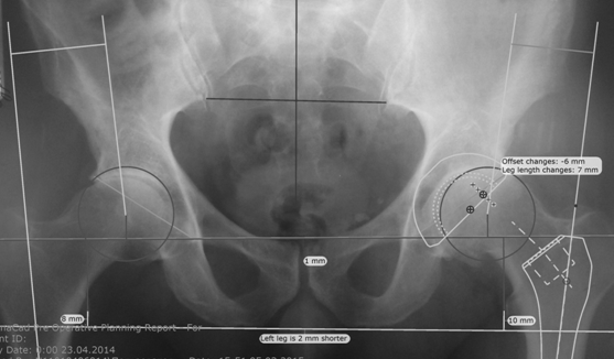 Рис. 3. Предоперационное планирование при помощи программы TraumaCad.