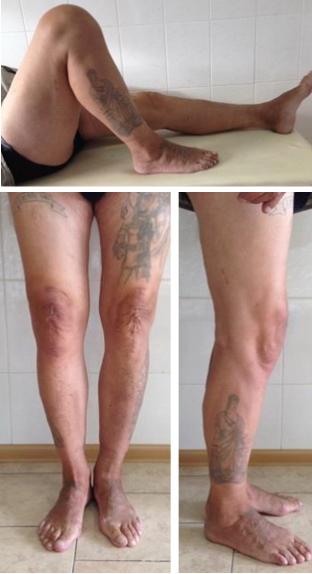 Рис. 6. Внешний вид пациента через год после операции.