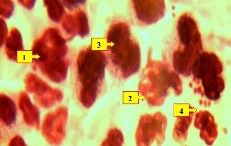 Рис. 5. Нейтрофильные лейкоциты (1) в состоянии кариолизиза и кариопикноза ядерных структур, (разрушенные лейкоциты (2), лимфоциты (3), микроорганизмы (4)) . Окраска: Ромоновский-Гимза. Ув: ок.10, об. 40. 